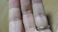 指の怪我